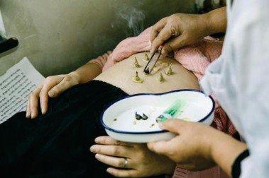 Acupuncture Therapy